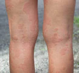 Treatment of Hives
