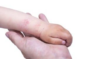 How to Identify Eczema and Psoriasis