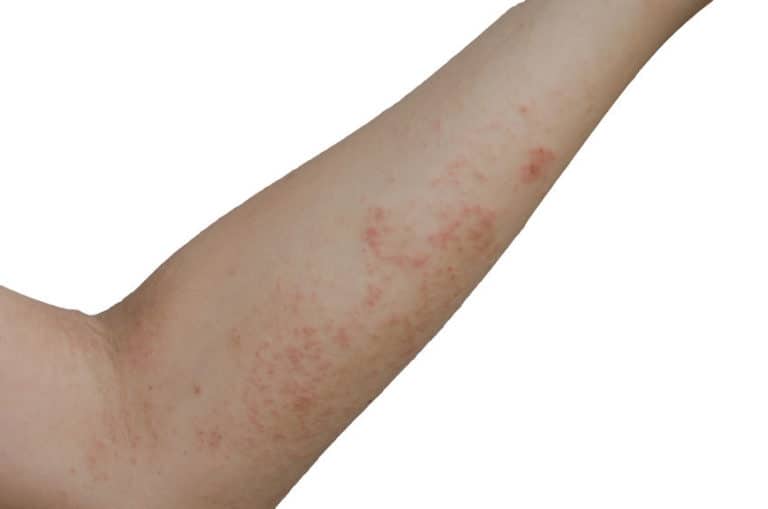 What Is Contact Dermatitis? How Is It Treated? 3 Big Tips