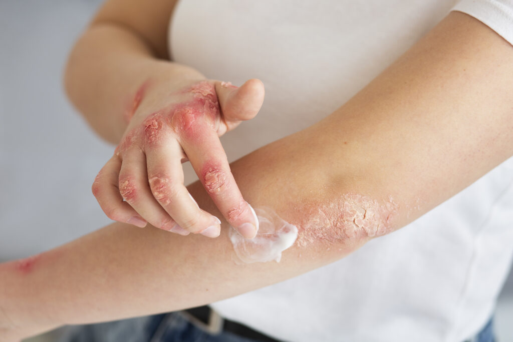 Contact Dermatitis Treatment in Spring Hill, FL